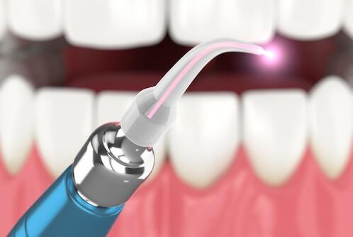 laser dentistry west seattle