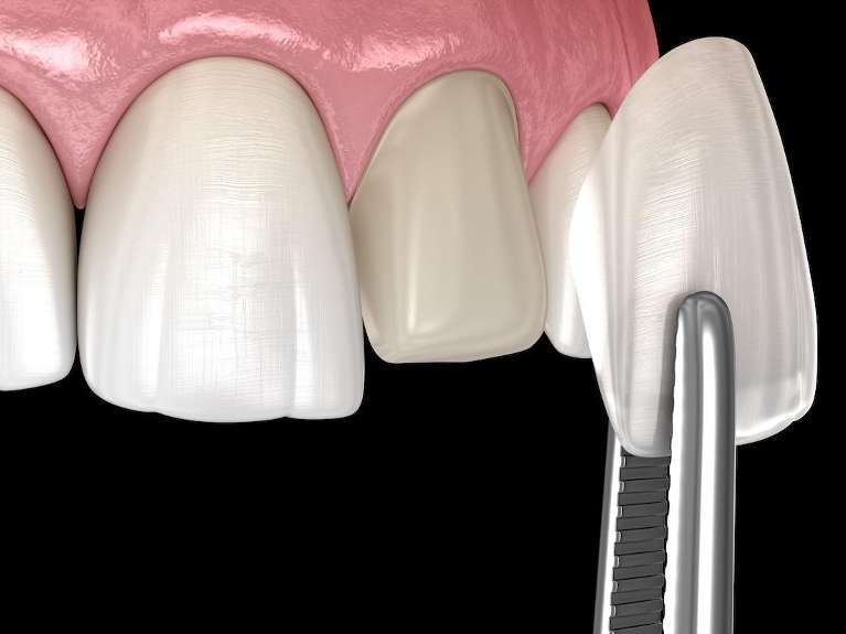 veneers seattle | veneer being placed on tooth