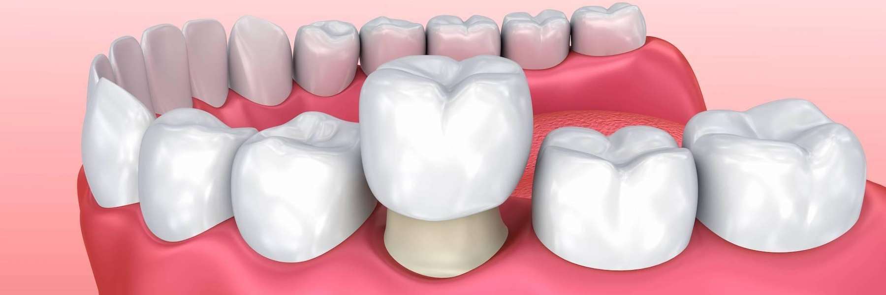 dental crown | west seattle dentist