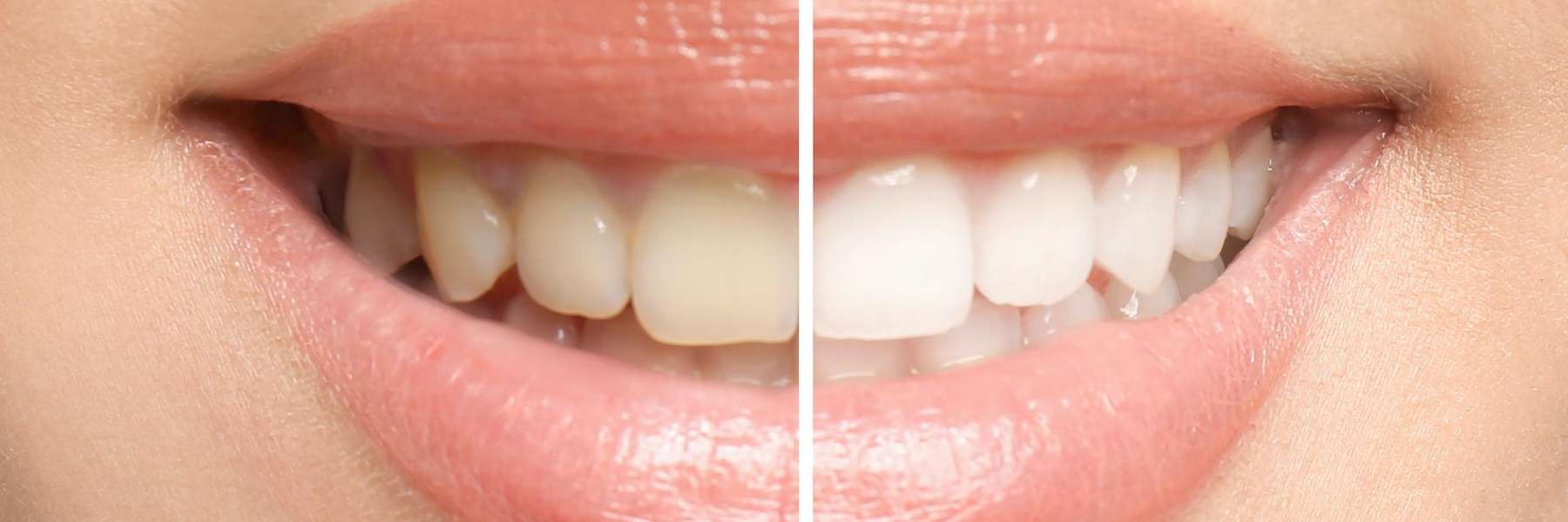 seattle teeth whitening | before and after whitening